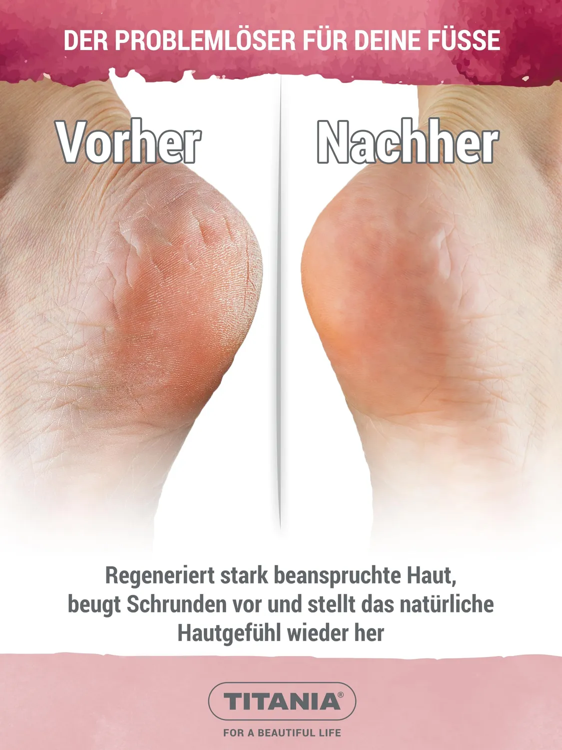 Titania Schrunden Salbe 25% Urea 75 ml 2er Pack